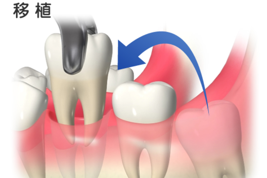 自家歯牙移植（歯の移植）とは？ - つゆくさ歯科医院（名古屋市緑区の歯医者）